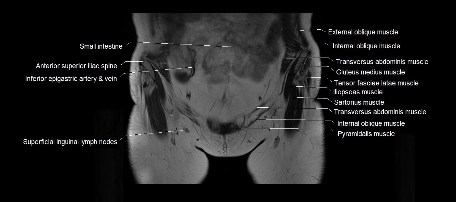 MRI 3T pelvis coronal cross section anatomy image 3.webp